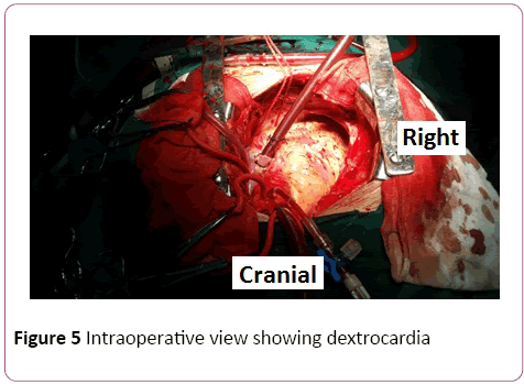 Double Valve Replacement In A Patient With Dextrocardia And Situs Inversus Toatalis A Case Report Insight Medical Publishing Double Valve Replacement In A Patient With Dextrocardia And Situs Inversus Toatalis A Case Report Insight Medical Publishing