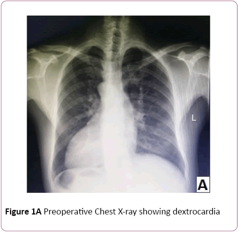 Double Valve Replacement In A Patient With Dextrocardia And Situs Inversus Toatalis A Case Report Insight Medical Publishing Double Valve Replacement In A Patient With Dextrocardia And Situs Inversus Toatalis A Case Report Insight Medical Publishing