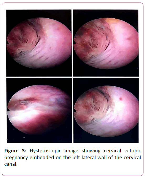 Management of Live Cervical Ectopic Pregnancy | Insight ...